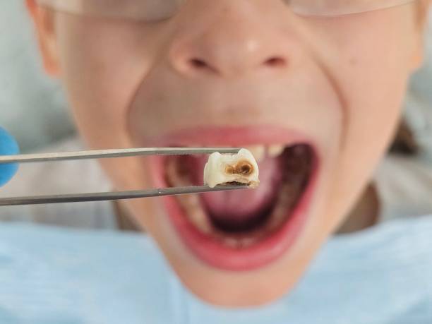 Best Emergency Tooth Extraction in Hanley Hills, MO